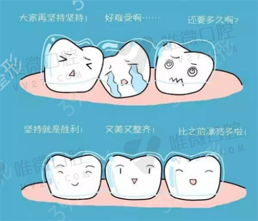 做一次窝沟封闭能管多久,窝沟封闭进口与国产区别(图1)